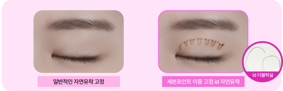 세미아웃 수술 방법