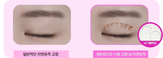 세미아웃 수술 방법