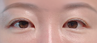 아이디병원 - 눈밑지방재배치 - BEFORE & AFTER - AFTER 1M