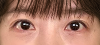 아이디병원 - 눈밑지방재배치 - BEFORE & AFTER - AFTER 1M