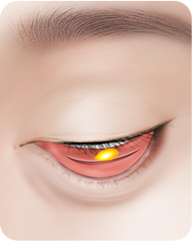 아이디병원 - 눈밑지방재배치 - HOW TO ? - 눈 안쪽 결막을 절개해 불필요한 지방만을 제거