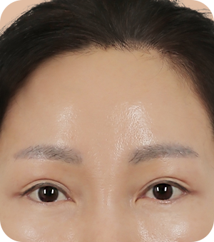 흉터 걱정 없이 또렷한 인상