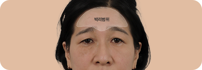 이마~관자놀이, 미간까지 박리 후 SMAS층까지 확실한 고정!