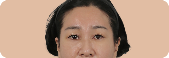 흉터 없이 깊은 이마주름, 처진 눈매, 눈썹, 미간 주름까지 올인원 개선!