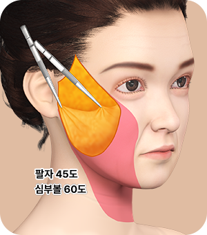 처짐 정도에 따라 id 만의 기술력으로 리프팅 후 3중 고정 