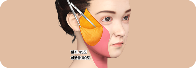 처짐 정도에 따라 id 만의 기술력으로 리프팅 후 3중 고정 