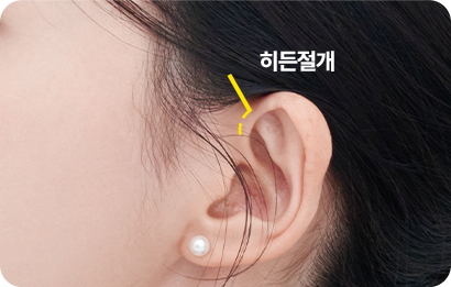 헤어라인의 약 1cm 히든절개로 흉터 부담 최소화