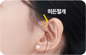 아이디병원 - 미니심부거상술 - 미니 심부거상술 수술 방법 - 헤어라인의 약 1cm 히든절개로 흉터 부담 최소화