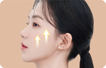 피부의 처진 조직을 수직방향으로 리프팅