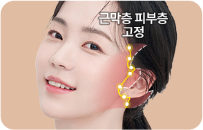 아이디병원 - 미니심부거상술 - 미니 심부거상술 수술 방법 - 표피~근막층(SMAS)까지 4중 구조를 단단하게 고정