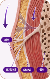 아이디병원 - 중안부 리프팅 - 중력으로 인한 처짐 - 리프팅
