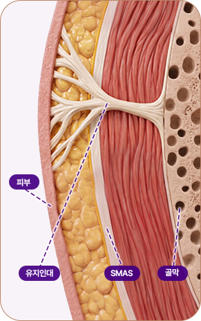 아이디병원 - 중안부 리프팅 - 심부층까지 리프팅 된 모습 - 리프팅