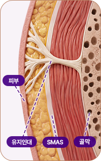 아이디병원 - 중안부 리프팅 - 심부층까지 리프팅 된 모습 - 리프팅
