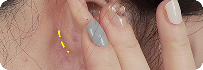 1CM 미니 귀뒤절개