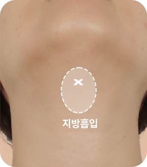 지방흡입 후 턱 아래 근육 묶기