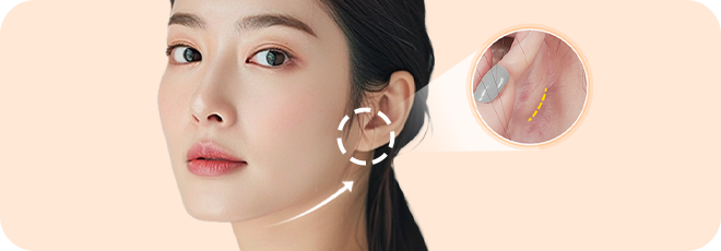 귀 뒤 1cm 최소 절개로 티나지 않는 흉터!