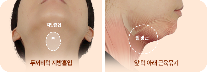 완벽한 V라인의 완성