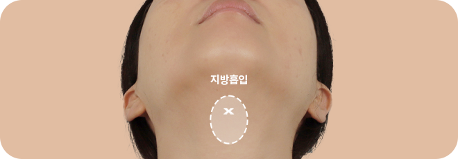 지방흡입 후 턱 아래 근육 묶기