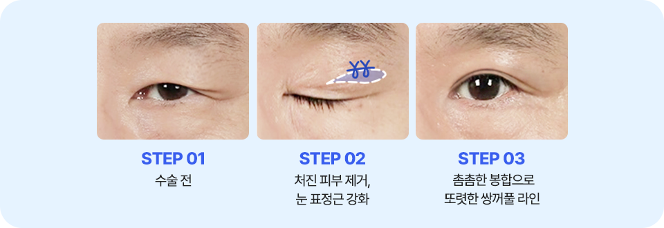 남자 상안검