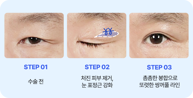 남자 상안검