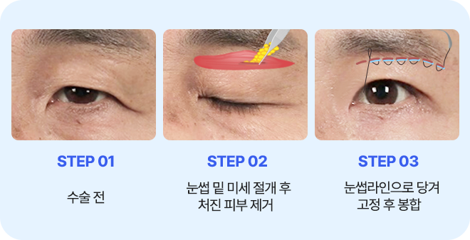 눈썹 거상술