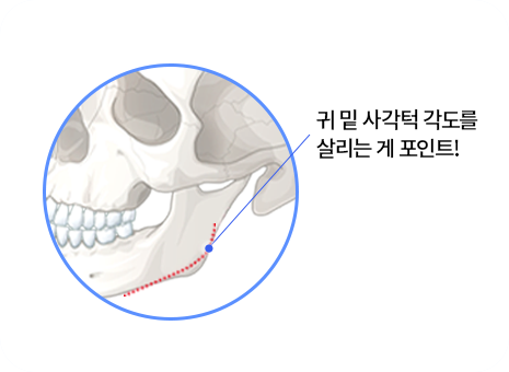 id-M 절골 수술법