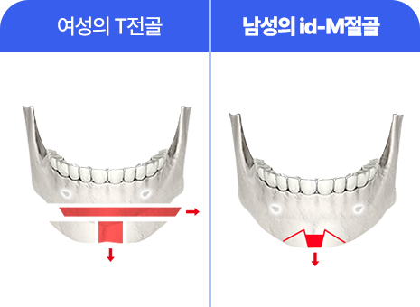 id-M 절골 수술법