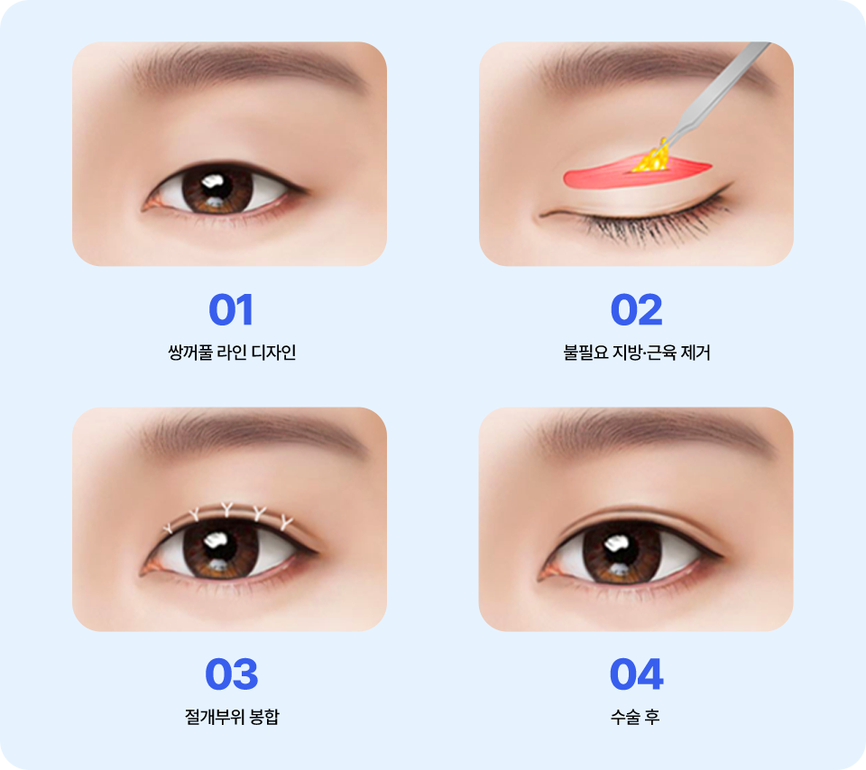 남자 자연유착 매몰
