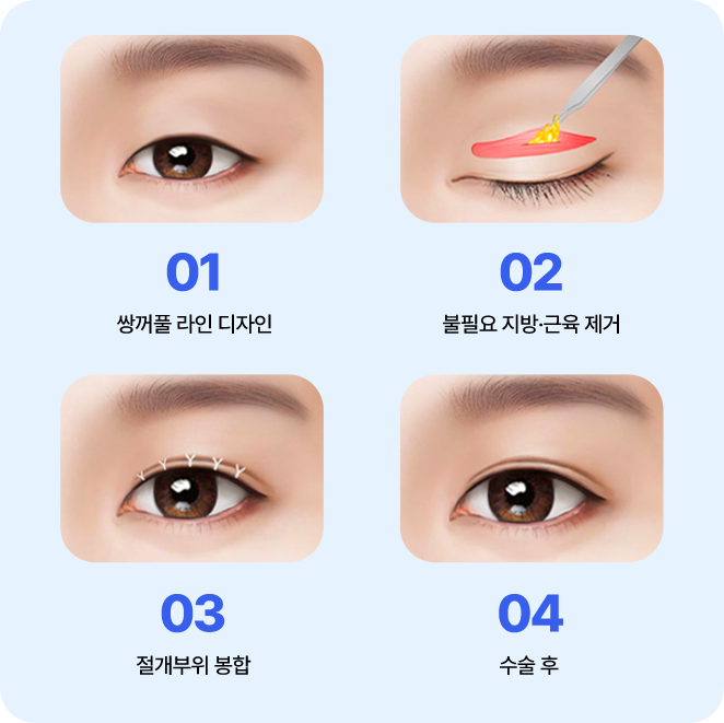 남자 자연유착 매몰