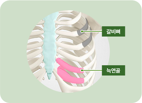 늑연골 사진