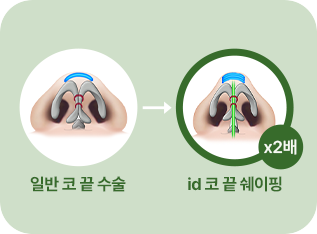 일반 코 끝 수술. id 코 끝 쉐이핑(x2배)
