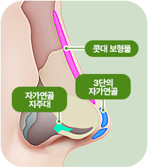 콧대 보형물. 자가연골 지주대. 3단의 자가연골