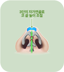 3단의 자가연골로 코 끝 높이 조절