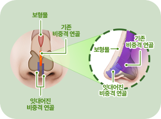 보형물. 기존 비중격연골. 잇대어진 비중격 연골